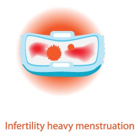 heavy menstruation thyroid problem